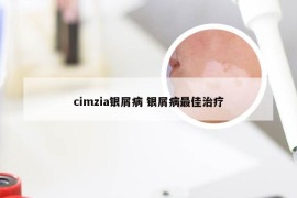 cimzia银屑病 银屑病最佳治疗