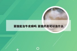 苗独能治牛皮癣吗 苗独药膏可以治什么