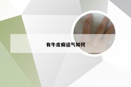 有牛皮癣运气如何