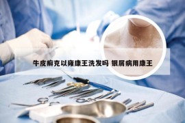 牛皮癣克以雍康王洗发吗 银屑病用康王