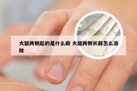 大腿两侧起的是什么癣 大腿两侧长藓怎么消除