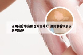 温州治疗牛皮癣医院哪家好 温州谁看银屑皮肤病最好
