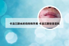 卡泊三醇水的功效和作用 卡泊三醇软膏百科