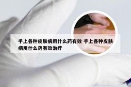 手上各种皮肤病用什么药有效 手上各种皮肤病用什么药有效治疗