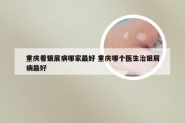 重庆看银屑病哪家最好 重庆哪个医生治银屑病最好
