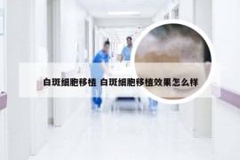 白斑细胞移植 白斑细胞移植效果怎么样
