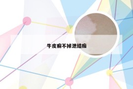 牛皮癣不掉泄结痂
