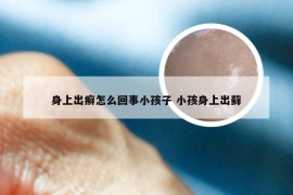 身上出癣怎么回事小孩子 小孩身上出藓