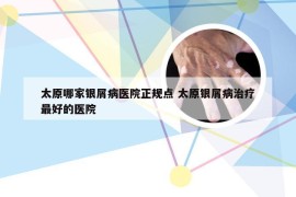 太原哪家银屑病医院正规点 太原银屑病治疗最好的医院