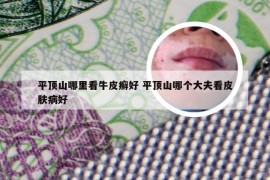 平顶山哪里看牛皮癣好 平顶山哪个大夫看皮肤病好