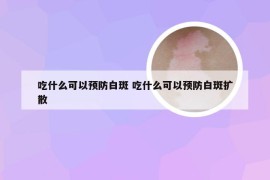 吃什么可以预防白斑 吃什么可以预防白斑扩散