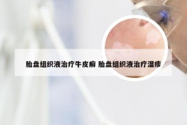 胎盘组织液治疗牛皮癣 胎盘组织液治疗湿疹