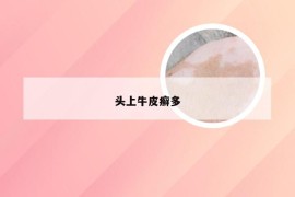 头上牛皮癣多