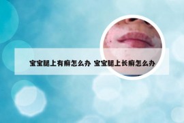 宝宝腿上有癣怎么办 宝宝腿上长癣怎么办