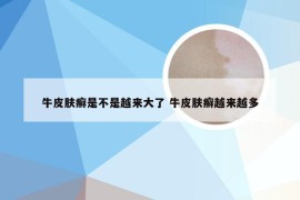 牛皮肤癣是不是越来大了 牛皮肤癣越来越多