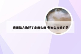 我用偏方治好了皮癣头癣 专治头皮癣的药