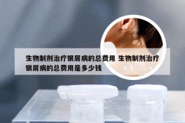 生物制剂治疗银屑病的总费用 生物制剂治疗银屑病的总费用是多少钱