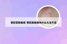 掌跎型脓疱症 掌跎脓疱病为什么久治不愈