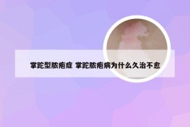 掌跎型脓疱症 掌跎脓疱病为什么久治不愈