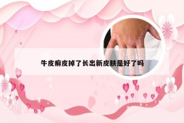牛皮癣皮掉了长出新皮肤是好了吗