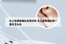头上有银屑病头皮发红吗 头上银屑病红斑一直红怎么办