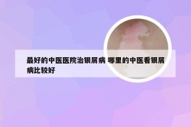 最好的中医医院治银屑病 哪里的中医看银屑病比较好