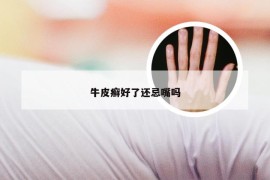 牛皮癣好了还忌嘴吗