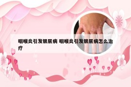 咽喉炎引发银屑病 咽喉炎引发银屑病怎么治疗