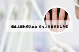 眼皮上面长癣怎么办 眼皮上面长癣怎么办呢