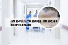 维生素d3能治疗银屑病吗巢 银屑病吃维生素d3的作用及功能