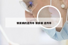 银屑病的遗传率 银屑病 遗传率