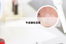 牛皮癣吃豆类
