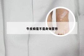 牛皮癣是不是身体营养