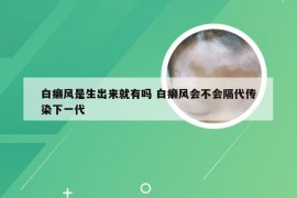 白癞风是生出来就有吗 白癞风会不会隔代传染下一代