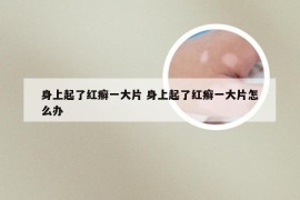 身上起了红癣一大片 身上起了红癣一大片怎么办