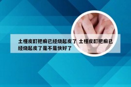 土槿皮酊把癣已经烧起皮了 土槿皮酊把癣已经烧起皮了是不是快好了