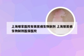 上海哪家医院有银屑病生物制剂 上海银屑病生物制剂医保医院