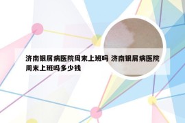 济南银屑病医院周末上班吗 济南银屑病医院周末上班吗多少钱