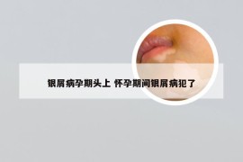 银屑病孕期头上 怀孕期间银屑病犯了