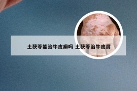 土茯苓能治牛皮癣吗 土茯苓治牛皮屑