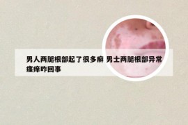 男人两腿根部起了很多癣 男士两腿根部异常瘙痒咋回事