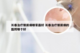 长春治疗银屑病哪家最好 长春治疗银屑病的医院哪个好