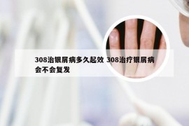 308治银屑病多久起效 308治疗银屑病会不会复发