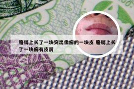 胳膊上长了一块突出像癣的一块皮 胳膊上长了一块癣有皮屑