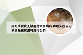 脚趾头脱皮无鳞屑是银屑病吗 脚趾头脱皮无鳞屑是银屑病吗用什么药