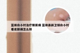 蓝田白小村治疗银屑病 蓝田县前卫镇白小村看皮肤病怎么样