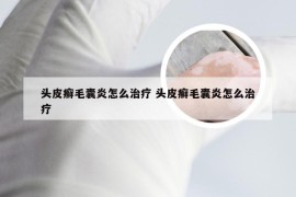 头皮癣毛囊炎怎么治疗 头皮癣毛囊炎怎么治疗