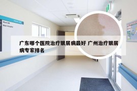 广东哪个医院治疗银屑病最好 广州治疗银屑病专家排名