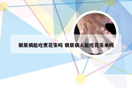 银屑病能吃煮花生吗 银屑病人能吃花生米吗