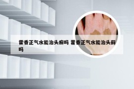 霍香正气水能治头癣吗 藿香正气水能治头藓吗